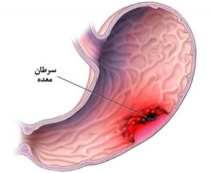 سرطان معده چیست؟عوامل ایجاد سرطان معده و روش های درمانی