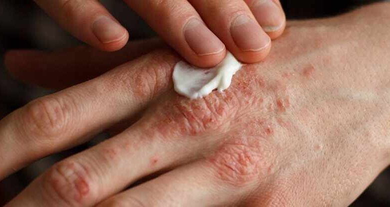 هنگام ابتلا به اگزما چه اتفاقی در پوست می افتد فیلاگرین